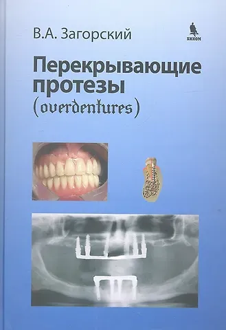 Валерий Арсентьевич Загорский Перекрывающие протезы (overdentures)