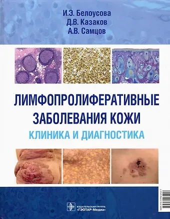 Лимфопролиферативные заболевания кожи. Клиника и диагностика